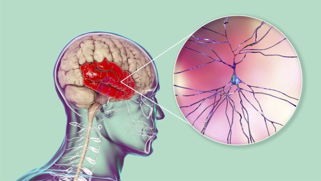Alcoholic effects on the brain encephalopathy